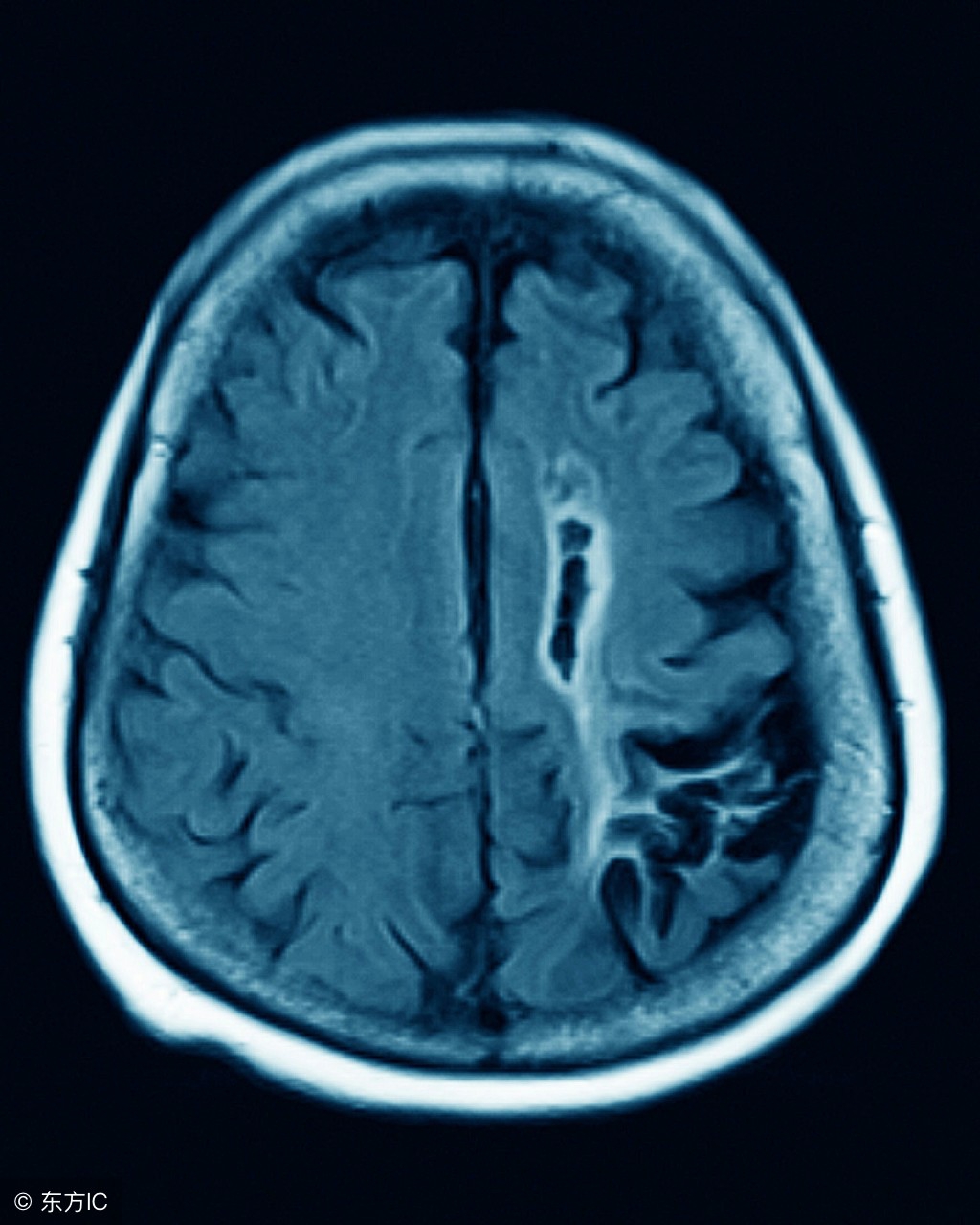小脑萎缩怎么治疗奥拉西坦最有效,小脑萎缩导致走路不稳可以治疗吗
