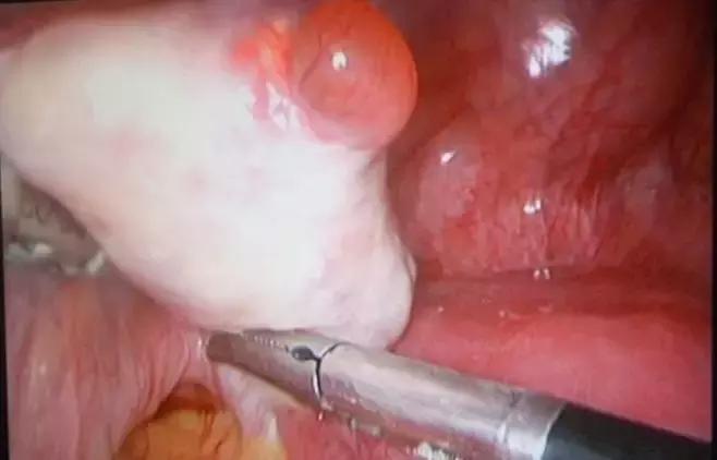 排卵期出血是怎么回事？关于排卵期5大疑问！