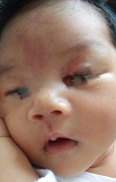 面部鲜红斑痣对求职影响,红胎记和鲜红斑痣能消失吗