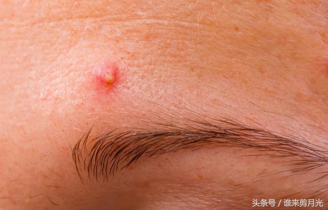 眉毛上长痘是怎么解决,眉毛长痘特别大很疼硬硬的