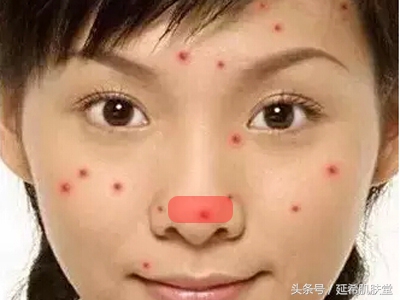 下巴不停冒脓包型痘痘怎么样调理,下巴长满痘痘是什么原因怎么调理