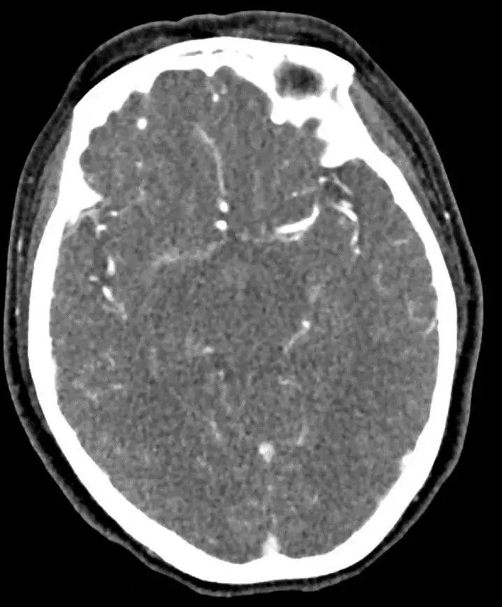 复旦大学附属中山医院放射科病例讨论（八十四）