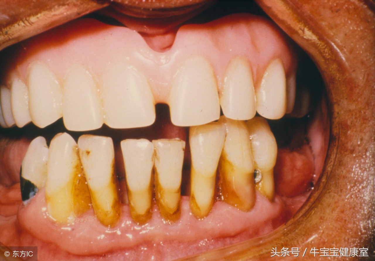40岁牙齿大量脱落怎么补救,成年后牙齿掉了如何才能再长出来