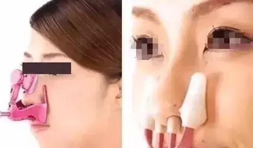 整形“神器”大测评：传说中的隆鼻夹真的靠谱吗？