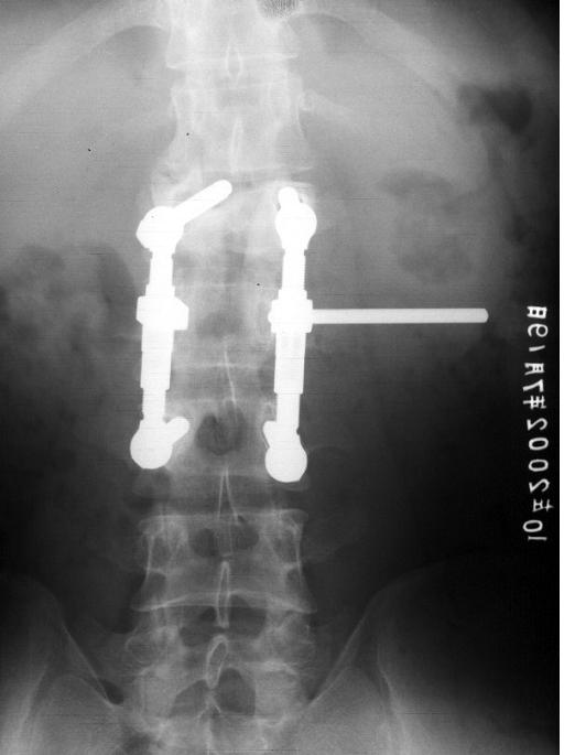 骨质疏松脊柱压缩性骨折怎么治疗,脊柱及四肢骨折的治疗决策