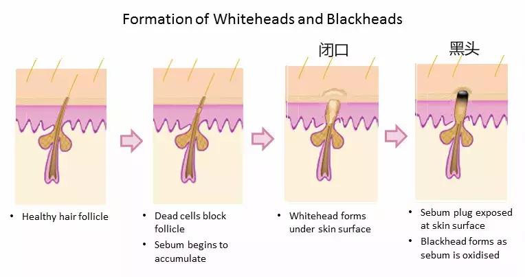 去黑头推荐学生党平价10元 (5元以内老国货去黑头产品学生党)