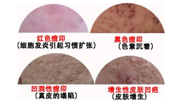 想要快速祛痘印你必须知道这的知识点