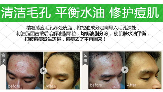 祛痘去痘印男生方法,男士怎么祛痘祛痘印效果好