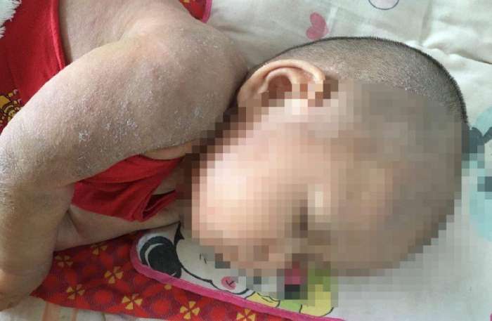 宝宝外阴湿疹 (宝宝癣状湿疹)