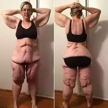 减肥后肚子皮肤松弛大概多久恢复,运动减肥后脸部皮肤松弛怎么办