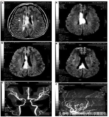 张景明教授讲脑中风后遗症,李医生讲中风视频全集
