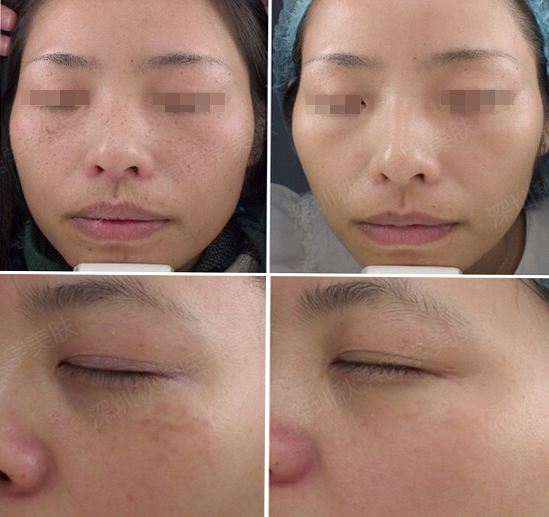 祛斑激光后如何选择护肤品,40多岁祛斑用什么激光好