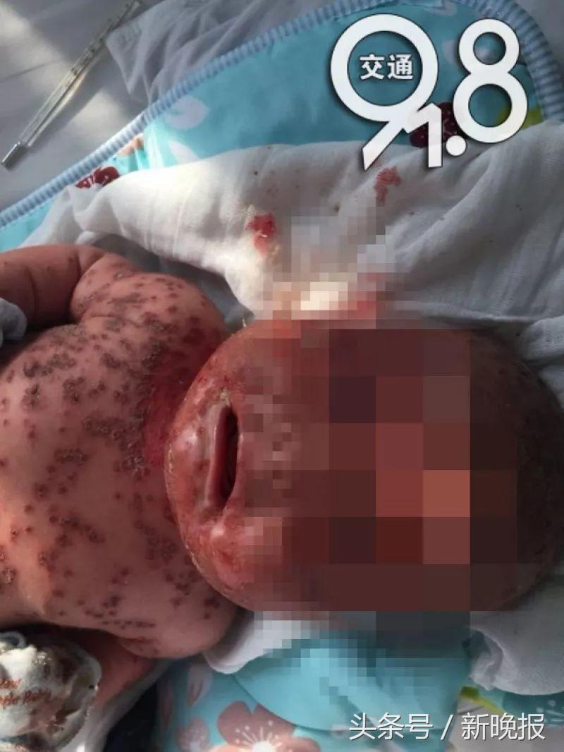 宝宝长疱疹三天自愈的最佳方法,千万别再让孩子做这几个动作了