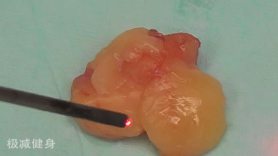 减肥抽脂的过程是怎样的,抽脂减肥的危害亲身经历