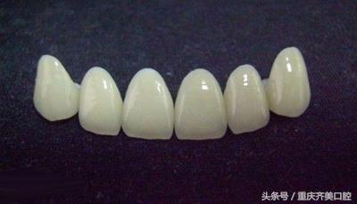 怎么能辨别烤瓷牙的好坏,怎么判断烤瓷牙品质
