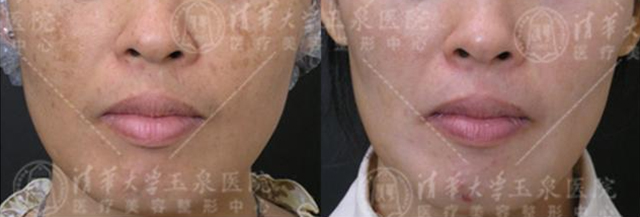 褐斑有几种,褐青色斑什么原因