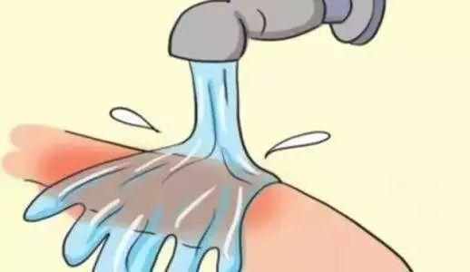 烧水烫伤紧急处理,烫伤烧伤的紧急处理ppt