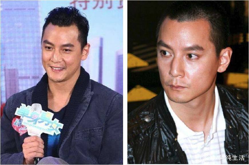 发际线脱发的原因和治疗方法,不要让发际线后移