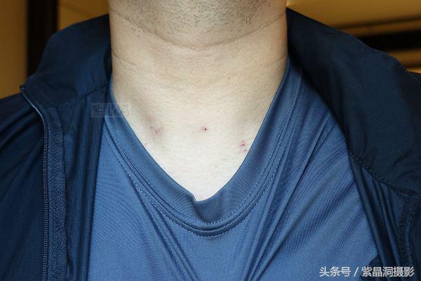 甲状腺结节手术需要住院几天出院,甲状腺结节做消融手术多少天出院