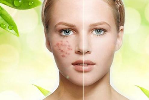 教你解决痘痘,8个实战妙招告别痘痘脸