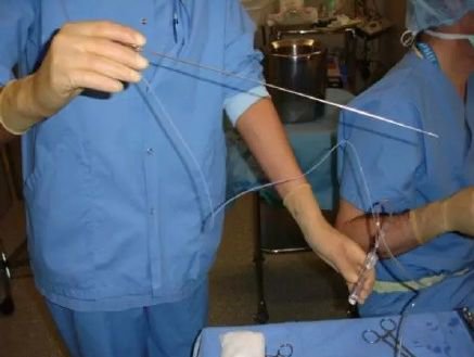 女大学生捐卵20颗,女孩捐卵20颗死亡