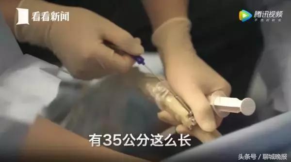 18岁姑娘多次捐卵致生命垂危,女学生捐卵新闻