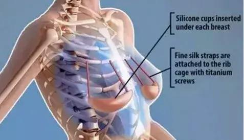 最危险的整容手术是隆胸吗,整容手术隆胸真实案例