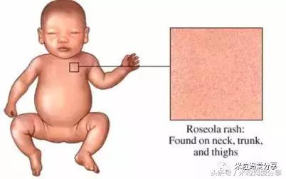 宝宝起疹的最佳治疗方法,孩子发烧后出疹怎么护理