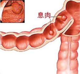 胃肠息肉手术多少钱,胃肠息肉的症状表现