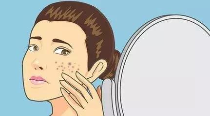 挤黑头痘痘粉刺闭口,怎么去除闭口痘