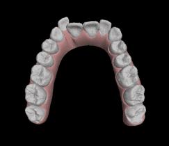 阿娇整牙,阿娇整牙前后对比