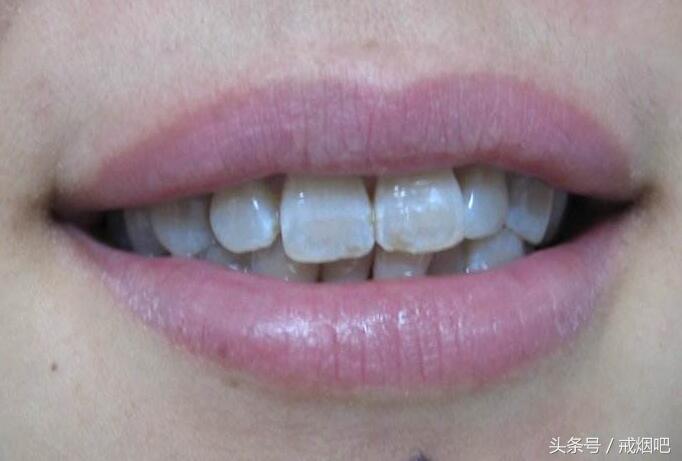 经常吸烟有多可怕,长期吸烟的嘴长什么样