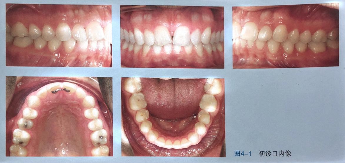 牙齿上的黑三角怎么去除,去除牙齿黑三角的神器