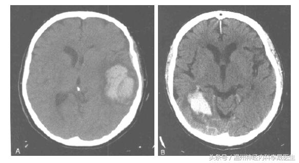 脑出血李医生,脑出血病例分析及答案