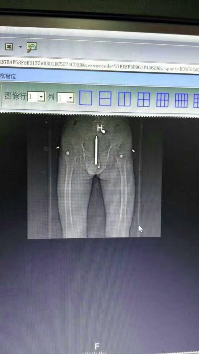 泌尿不适有异物排出怎么办,泌尿系异物是怎么回事