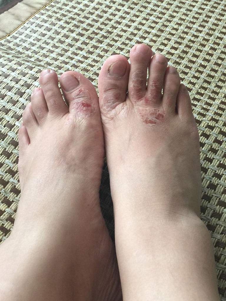 治疗脚气的最好办法又简单又实用,真实有效的治脚气药