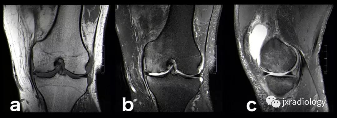 膝关节骨髓水肿疼痛特点,膝关节骨髓水肿的临床表现