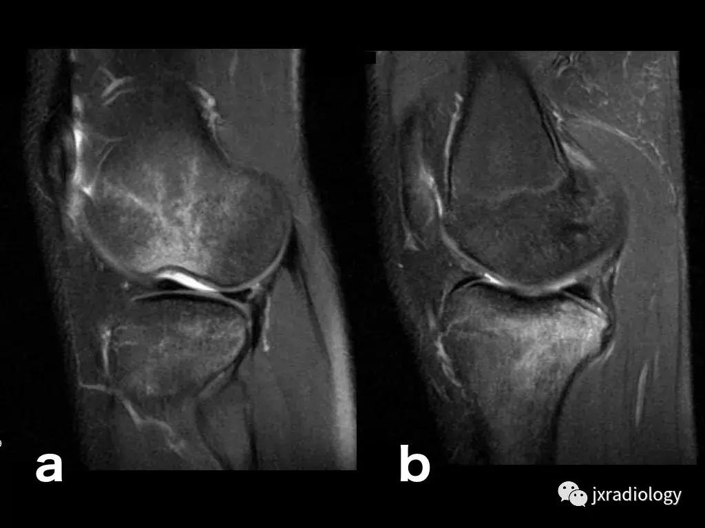 膝关节骨髓水肿疼痛特点,膝关节骨髓水肿的临床表现