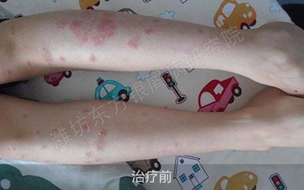 治疗牛皮癣全国最佳医院,2020年国家根治牛皮癣特效药