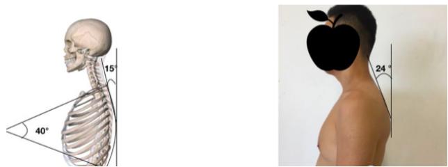 康复医生纠正驼背,如何矫正驼背简单办法