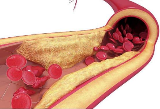甘油三酯高到多少会引起动脉硬化,甘油三酯超过多少会造成动脉硬化