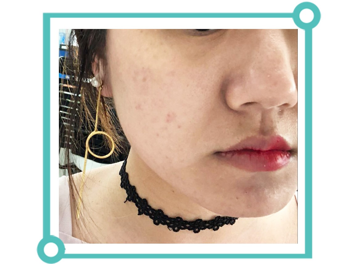 青少年痘印怎么消除小妙招,如何消除痘印祛痘