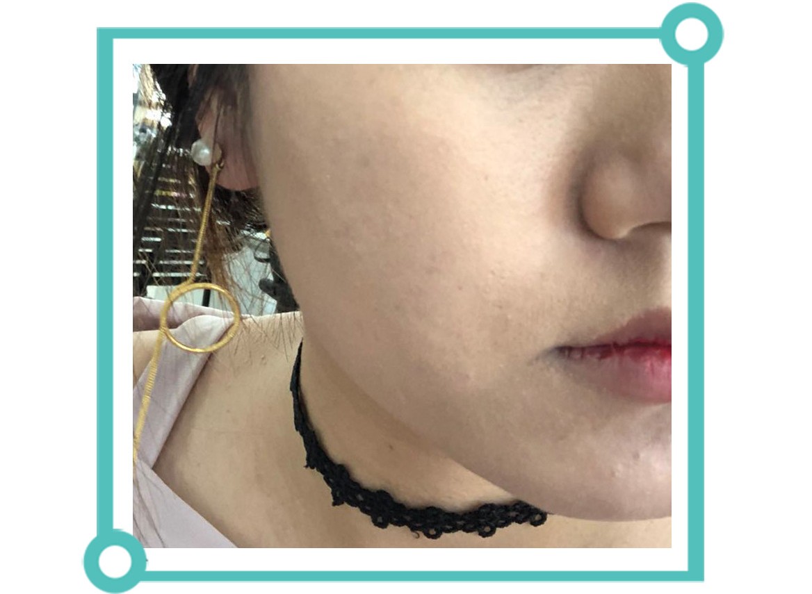 青少年痘印怎么消除小妙招,如何消除痘印祛痘