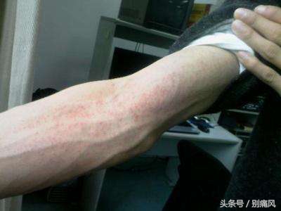 痛风药非布司他的副作用是什么,痛风发作每天吃20mg非布司他行吗