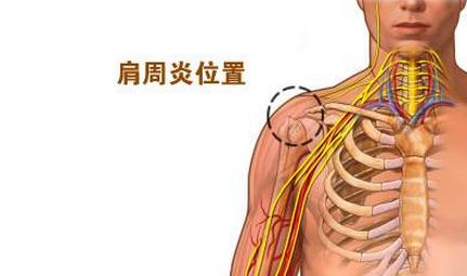肩周炎不能梳头发怎么办,肩周炎梳头发困难怎么锻炼视频