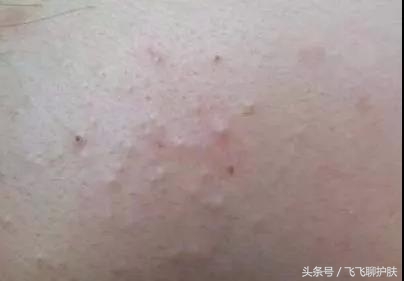 只有长痘才知道痘痘有多难治,要知道痘痘的根源