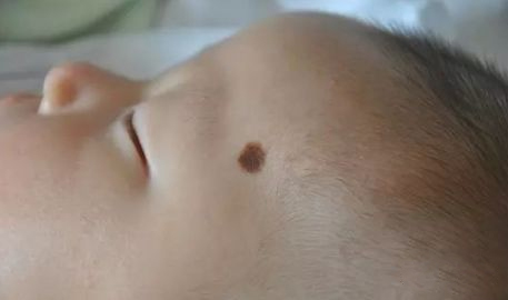 嘴上一个黑痣,嘴上有一颗很大的痣去掉后的图