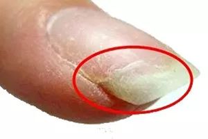 看指甲识健康,从指甲看疾病的图片说明