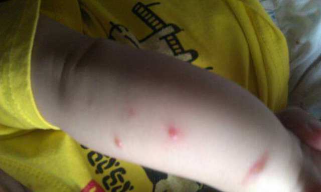 手足口水痘猩红热都得过,幼儿急疹猩红热水痘手足口鉴别