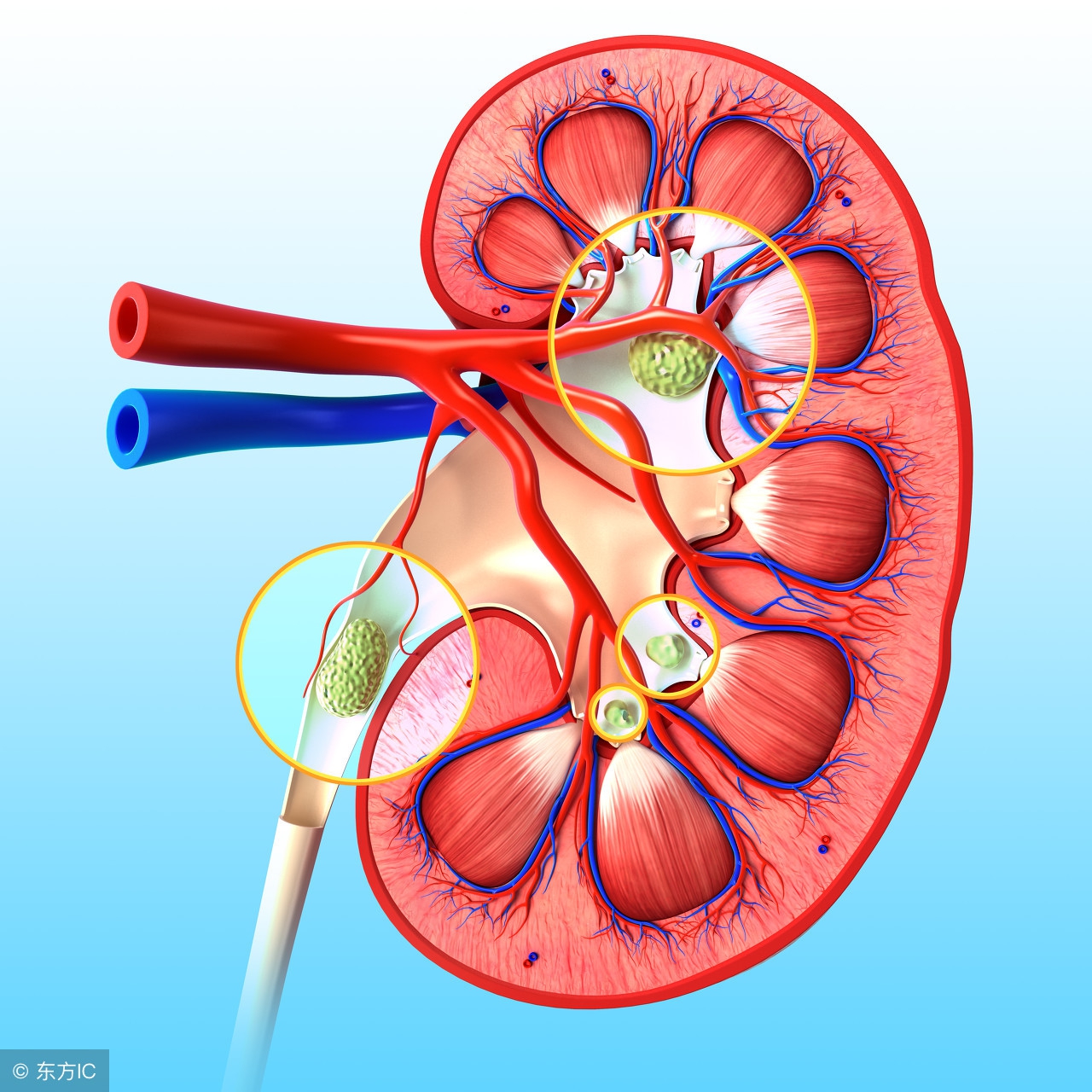 肾结石多少毫米能排石,肾结石多少mm会导致疼痛